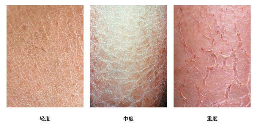 湿疹的症状图片是什么样